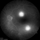 Multifocal Central Serous Chorioretinopathy Multifocal Central Serous Chorioretinopathy